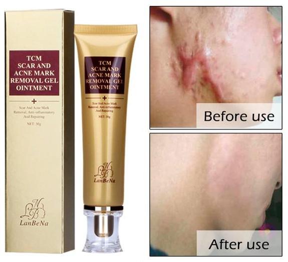 Acne Scar Remover Cream - Givemethisnow