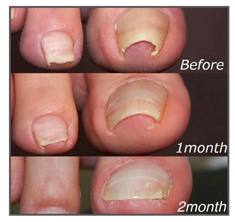 EasyPatches Correction patches for beautiful and healthy nails - Givemethisnow