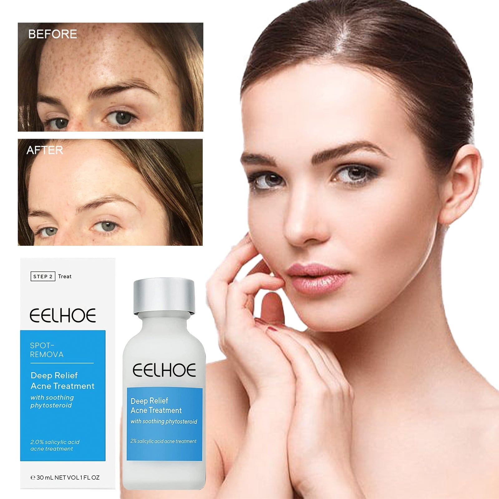 EELHOE™ Dark Spot and Acne Treatment Lotion - Givemethisnow