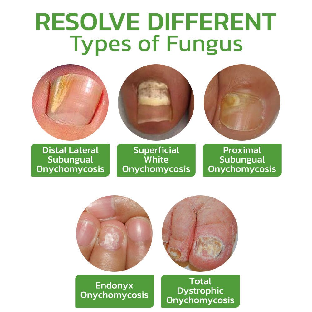 GFOUK™ 5 Days Nail Growth and Hardening Repair Roller - Givemethisnow