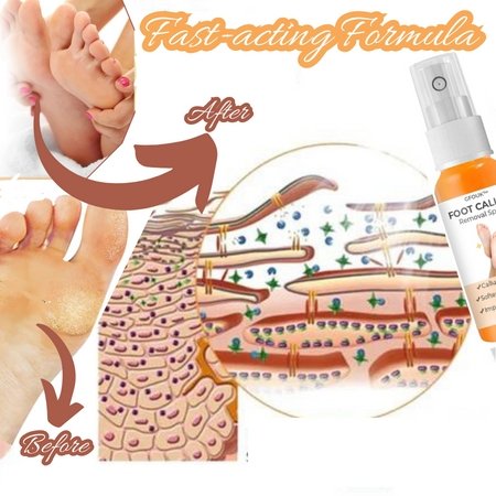 GFOUK™ Foot Callus Removal Spray - Givemethisnow