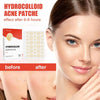 Hydrocolloid Acne Pimple Patch - Givemethisnow