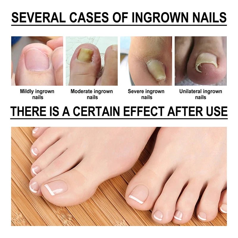 Ingrown Toenail Drops - Givemethisnow