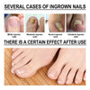 Ingrown Toenail Drops - Givemethisnow