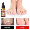 Ingrown Toenail Drops - Givemethisnow