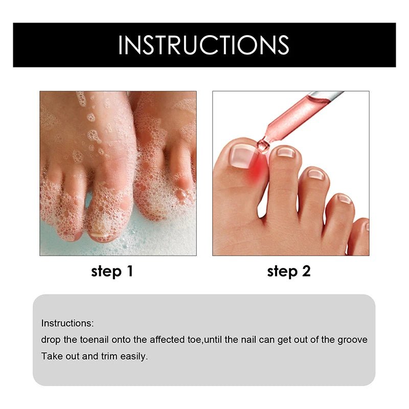 Ingrown Toenail Drops - Givemethisnow