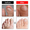 Ingrown Toenail Drops - Givemethisnow