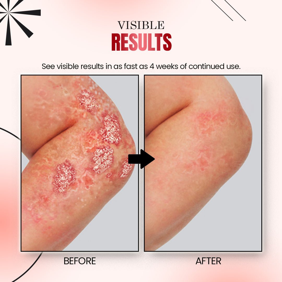 Psoriatrax Psoriasis Relief Spray - Givemethisnow