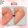 Psoriatrax Psoriasis Relief Spray - Givemethisnow