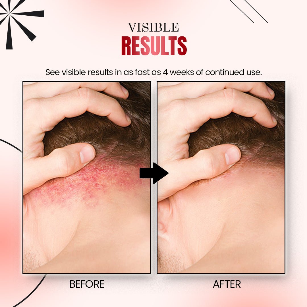 Psoriatrax Psoriasis Relief Spray - Givemethisnow