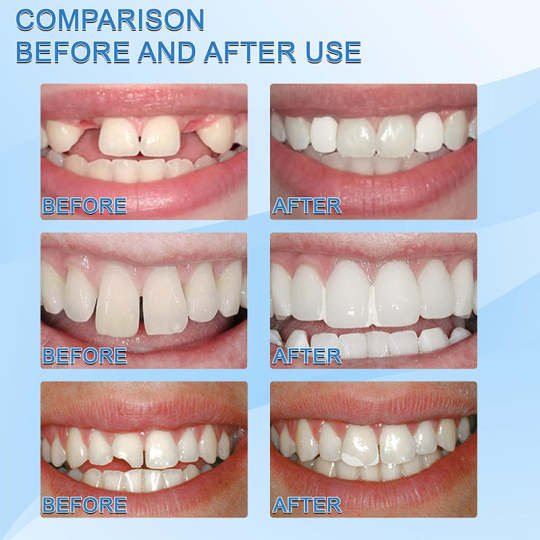 SmileSaver - Tooth Repair Beads - Givemethisnow