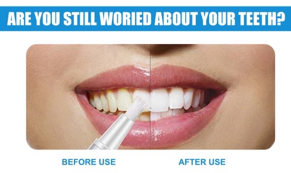 Sparkle Tooth Teeth Whitening Pen - Givemethisnow