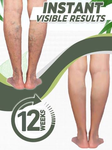 Varicose Veins Healing Patch - Givemethisnow