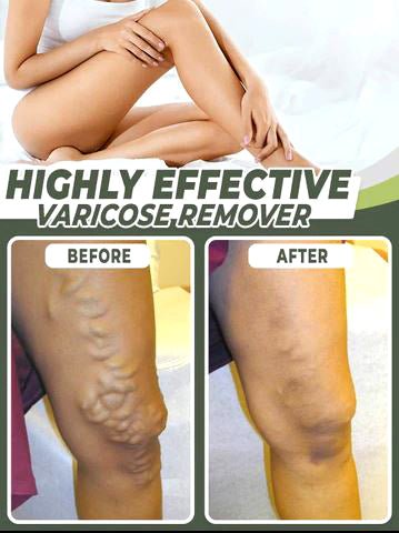 Varicose Veins Healing Patch - Givemethisnow